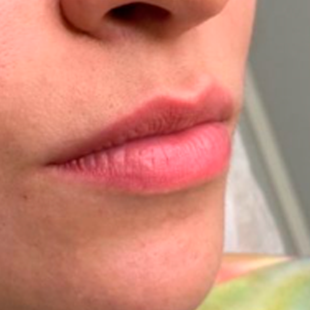 harmonização facial 1 harmonização facial 1