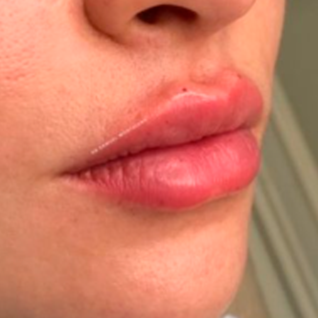 harmonização facial 2